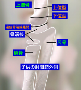 上腕骨顆上骨折の分類（側面）大阪市住吉区長居藤田鍼灸整骨院