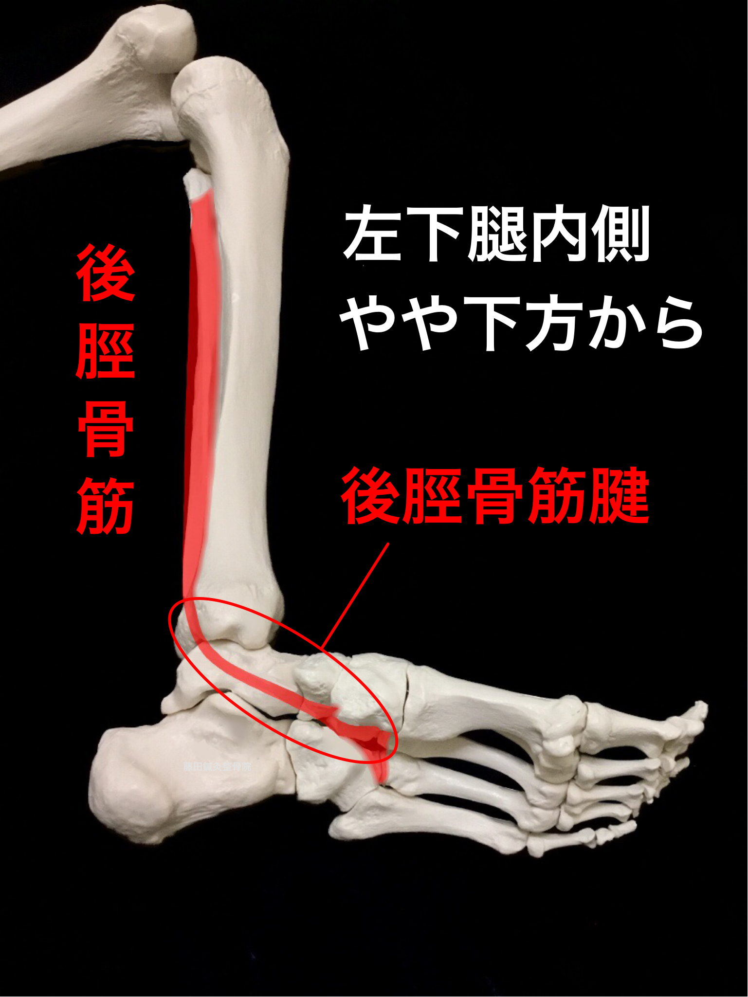 後脛骨筋腱炎 内くるぶしの後ろや下の部分の痛みや腫れ 藤田鍼灸整骨院