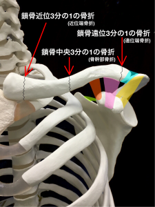 鎖骨骨折の分類|大阪市住吉区長居藤田鍼灸整骨院