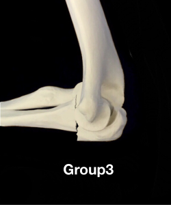 肘頭骨折Colton分類group3 鉤状突起部あるいは近位部での骨折に脱臼を伴う住吉区長居藤田鍼灸整骨院