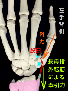第1中手骨基部骨折ーベンット骨折の転移イメージ背側