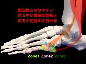 第五中足骨の血行分布と基部骨折の分類イメージ|住吉区長居藤田鍼灸整骨院