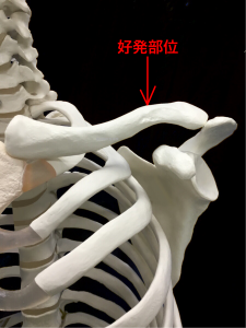 鎖骨骨折の好発部位|住吉区長居藤田鍼灸整骨院
