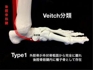 有痛性外脛骨ーVeitch分類Type1|大阪市住吉区長居藤田鍼灸整骨院