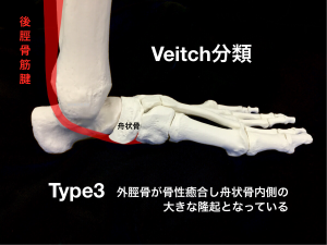 有痛性外脛骨ーVeitch分類Type3