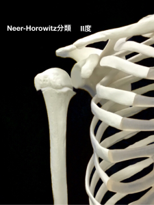 上腕骨近位骨端線離開ーNeer-Horwitz分類2度｜大阪市住吉区長居藤田鍼灸整骨院