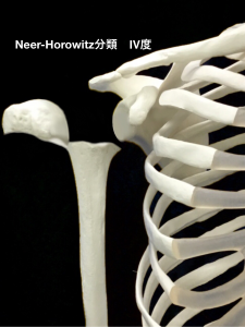 上腕骨近位骨端線離開ーNeer-Horwitz分類4度｜大阪市住吉区長居藤田鍼灸整骨院