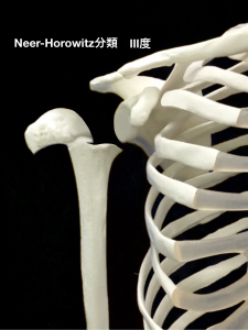 上腕骨近位骨端線離開ーNeer-Horwitz分類3度｜大阪市住吉区長居藤田鍼灸整骨院