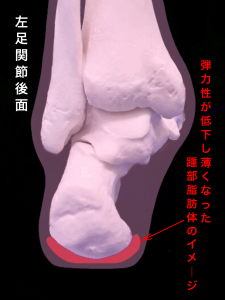 有痛性踵パットー踵部脂肪褥炎イメージ