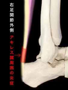 アキレス腱周囲炎のイメージ｜住吉区長居藤田鍼灸整骨院