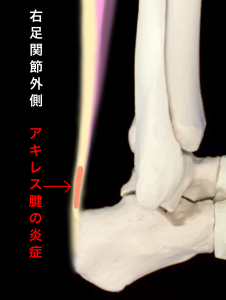アキレス腱炎のイメージ|大阪市住吉区長居藤田鍼灸整骨院