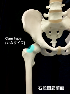 股関節インピンジメント症候群（FAI）Cam type (カムタイプ）|大阪市住吉区長居藤田鍼灸整骨院