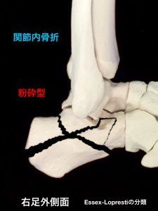 踵骨関節内骨折－粉砕型|大阪市住吉区長居藤田鍼灸整骨院