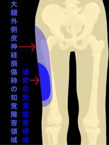 大腿外側皮神経の知覚障害部位|大阪市住吉区長居藤田鍼灸整骨院