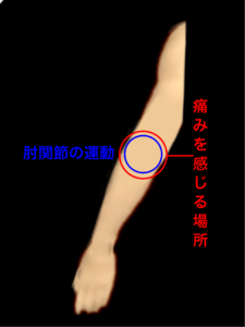 肘関節を構成する腱や靱帯、軟骨の障害｜住吉区藤田鍼灸整骨院