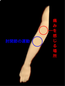 肘を動かすための筋肉の障害｜住吉区長居西藤田鍼灸整骨院